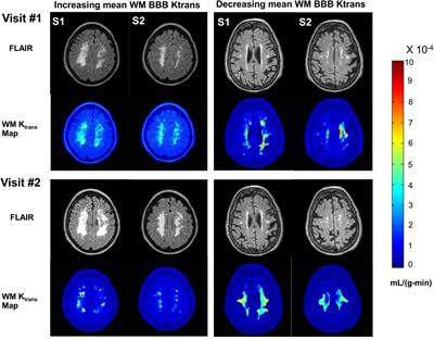 Barriers of the CNS transfer rate dynamics in patients with vascular cognitive impairment and dementia